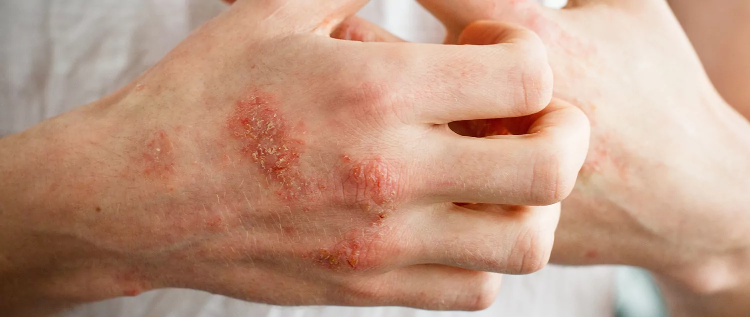   Contact Dermatitis