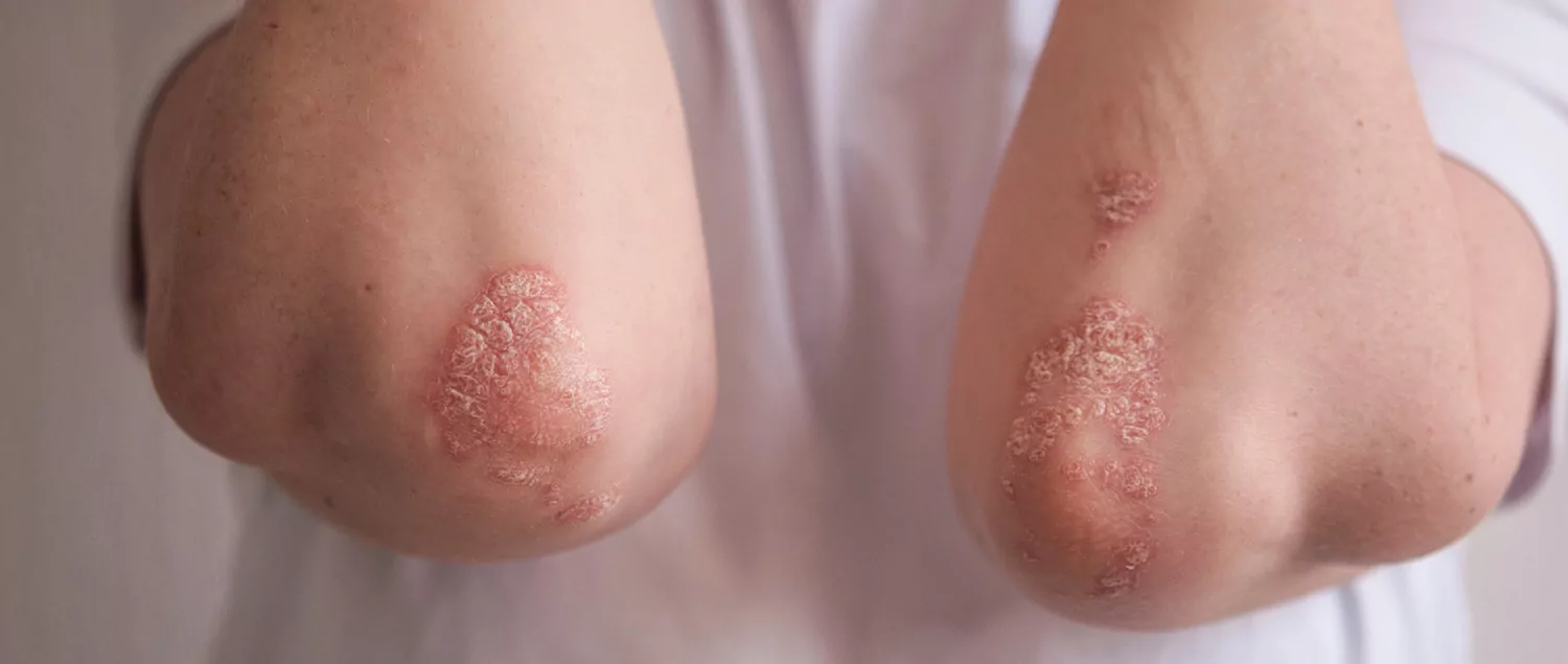 What is Contact Dermatitis?