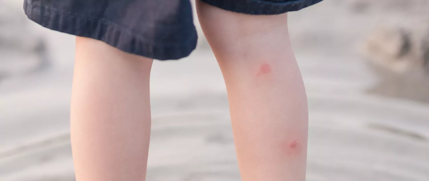 Jellyfish Bite