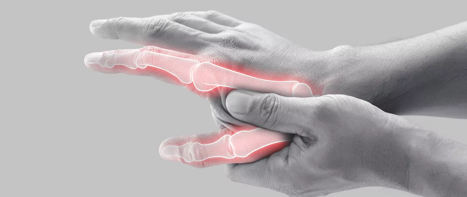 Rheumatoid Arthritis (Inflammatory Rheumatism)