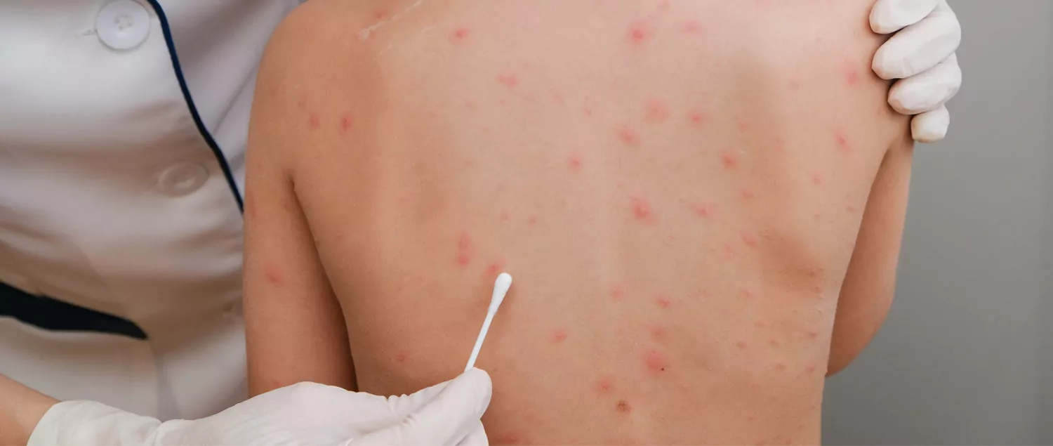 What is Chickenpox? What are the Symptoms?