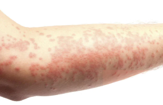 What is Histamine? What is Histamine Intolerance(Allergy)?